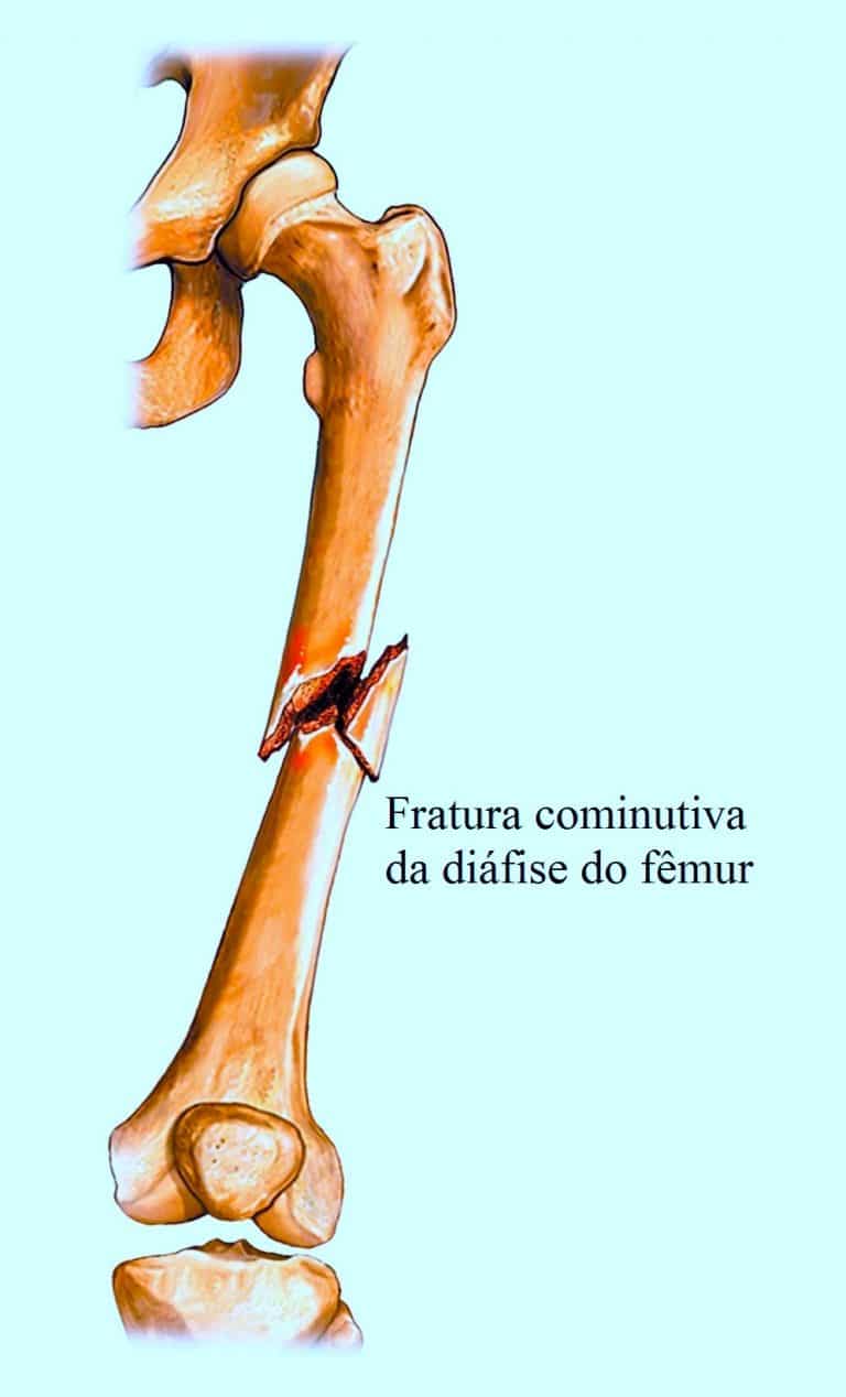 Fratura do fêmur em idosos sintomas tratamento fisioterapia e reabilitação