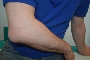Bursite Do Cotovelo Sintomas Tratamento E Cuidados P S Traum Tico