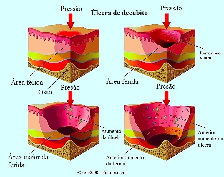 Sintomas de ulcera anal