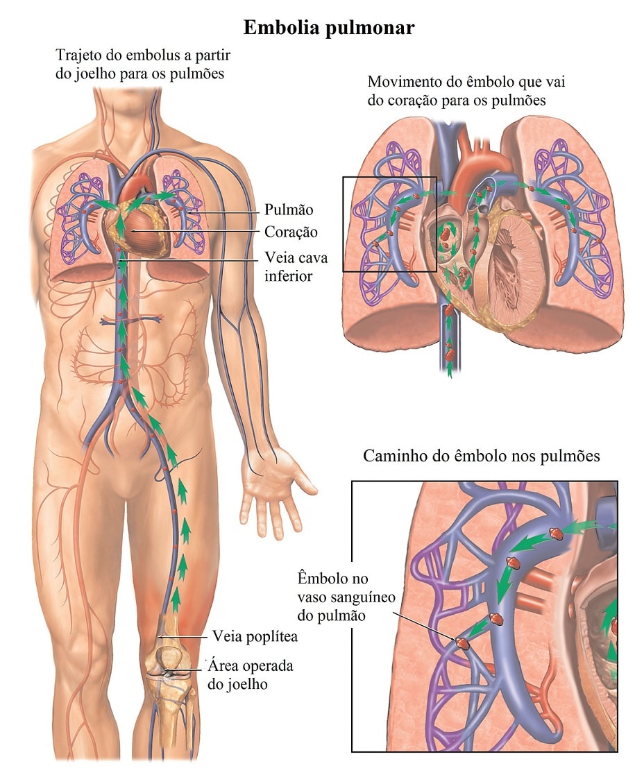 Derrame Pleural Pulmonar Causas Sintomas E Tratamento