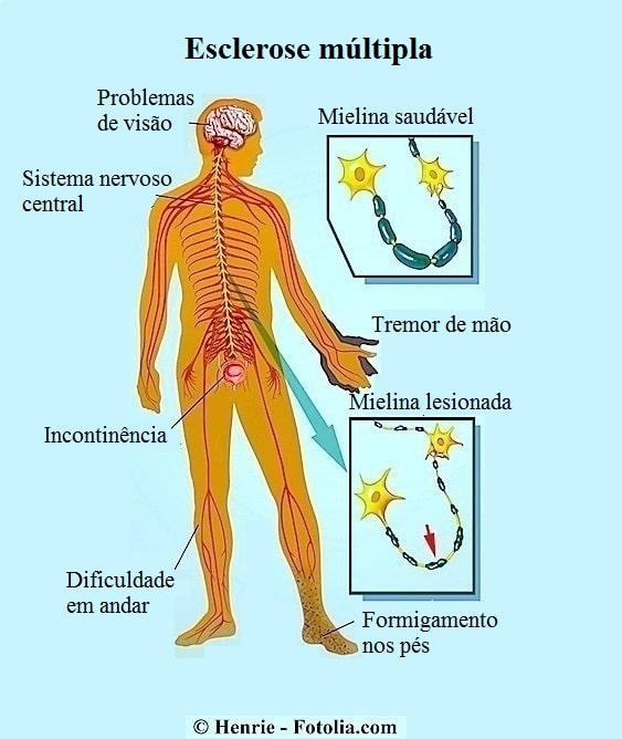 Esclerose Múltipla Sintomas E Causas Tipos Complicações Iniciais Fisioterapia Para Todos 3635