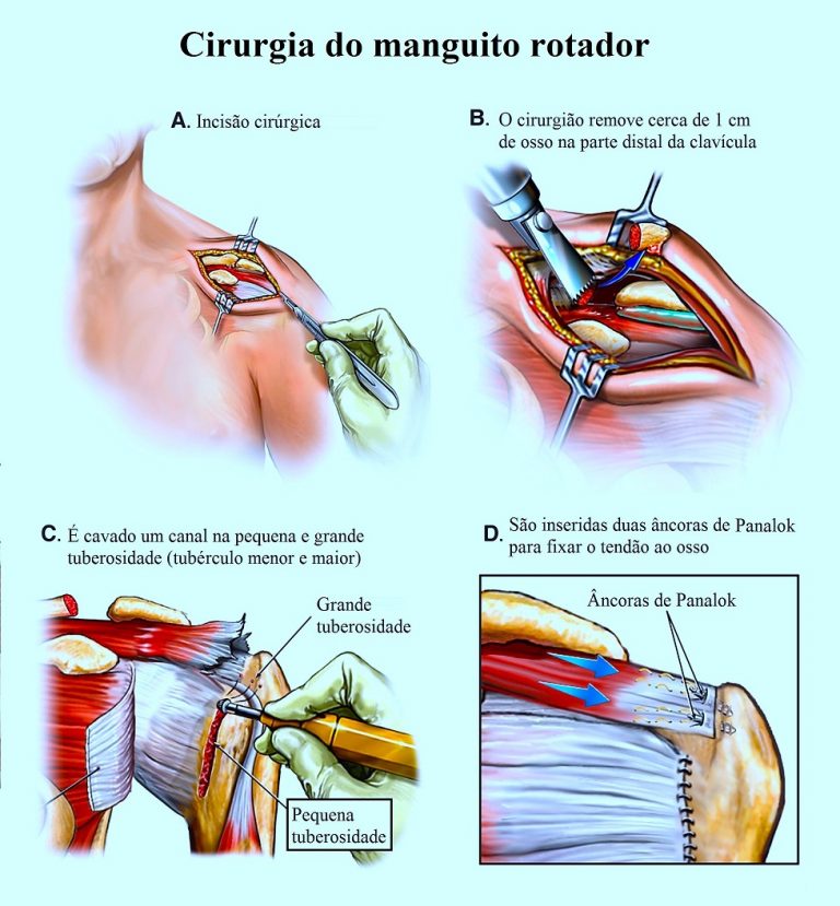 Tendinite Do Supraespinhoso Do Ombro Sintomas E Tratamento