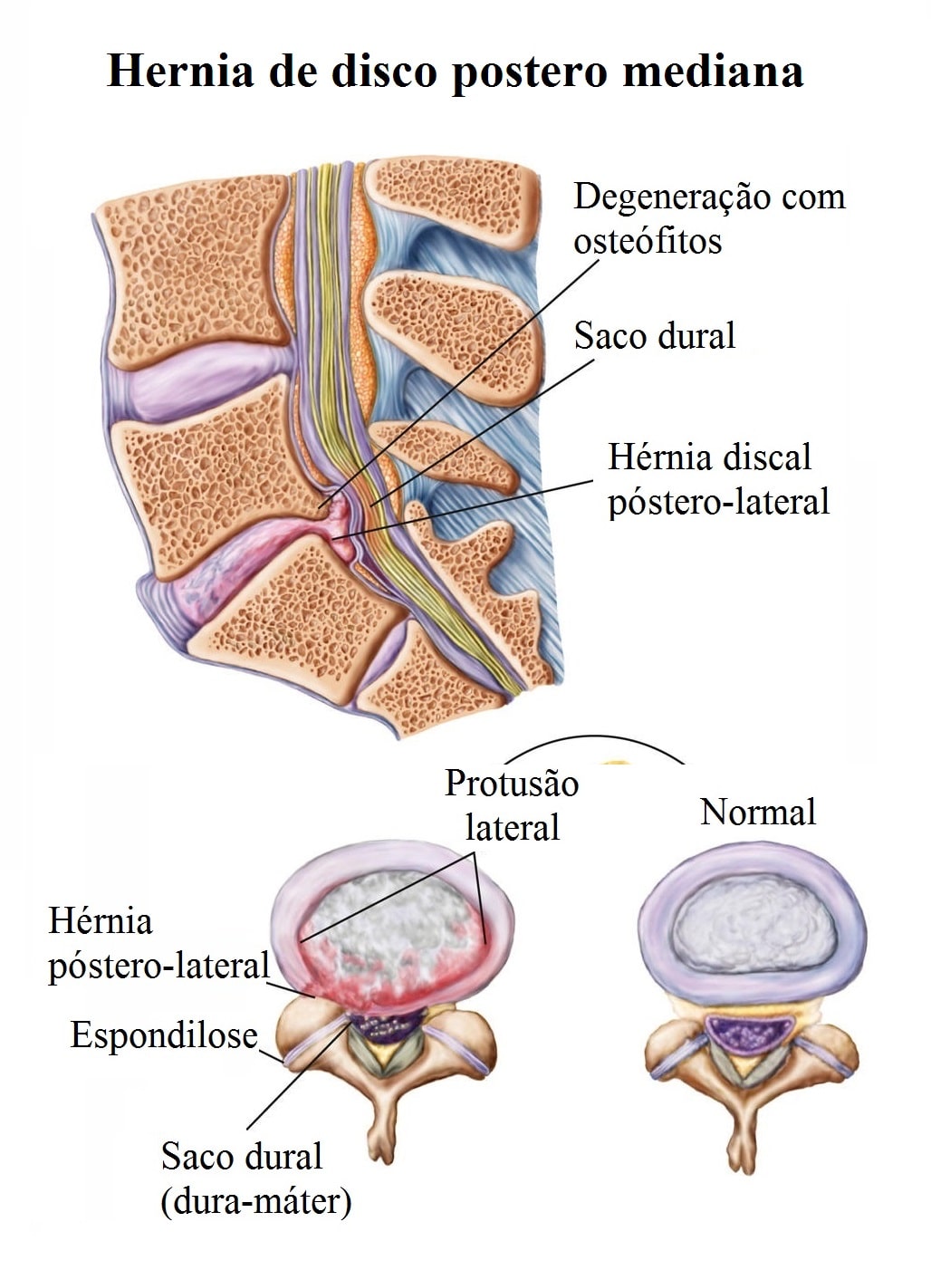 H Rnia De Disco Na Coluna Lombar Expulsa Central Ou Foraminal