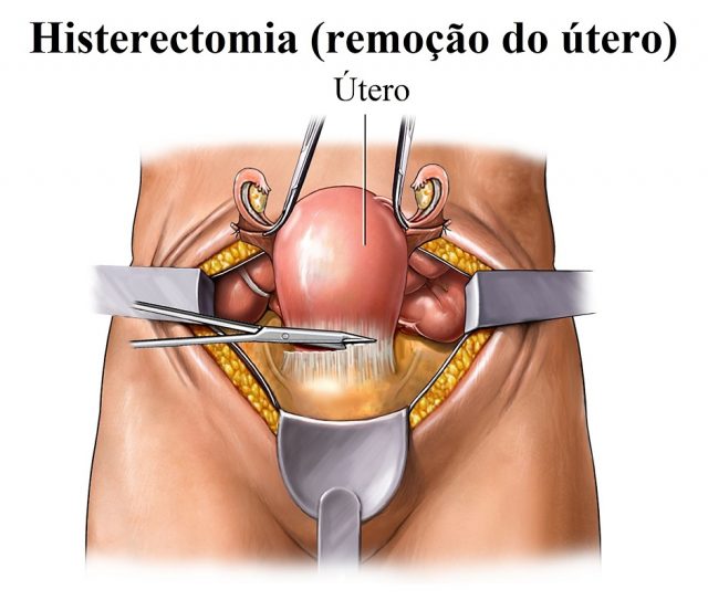 Mioma Uterino Ou Fibroma Sintomas Remoção E Riscos 