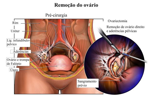 ▷ 1-histerectomia-total-abdominal-ooforectomia-bilateral