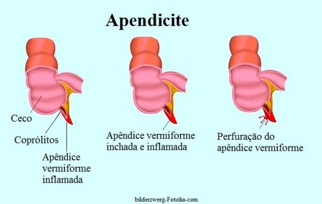 Sintomas Da Apendicite Aguda Ou Cr Nica E Cirurgia