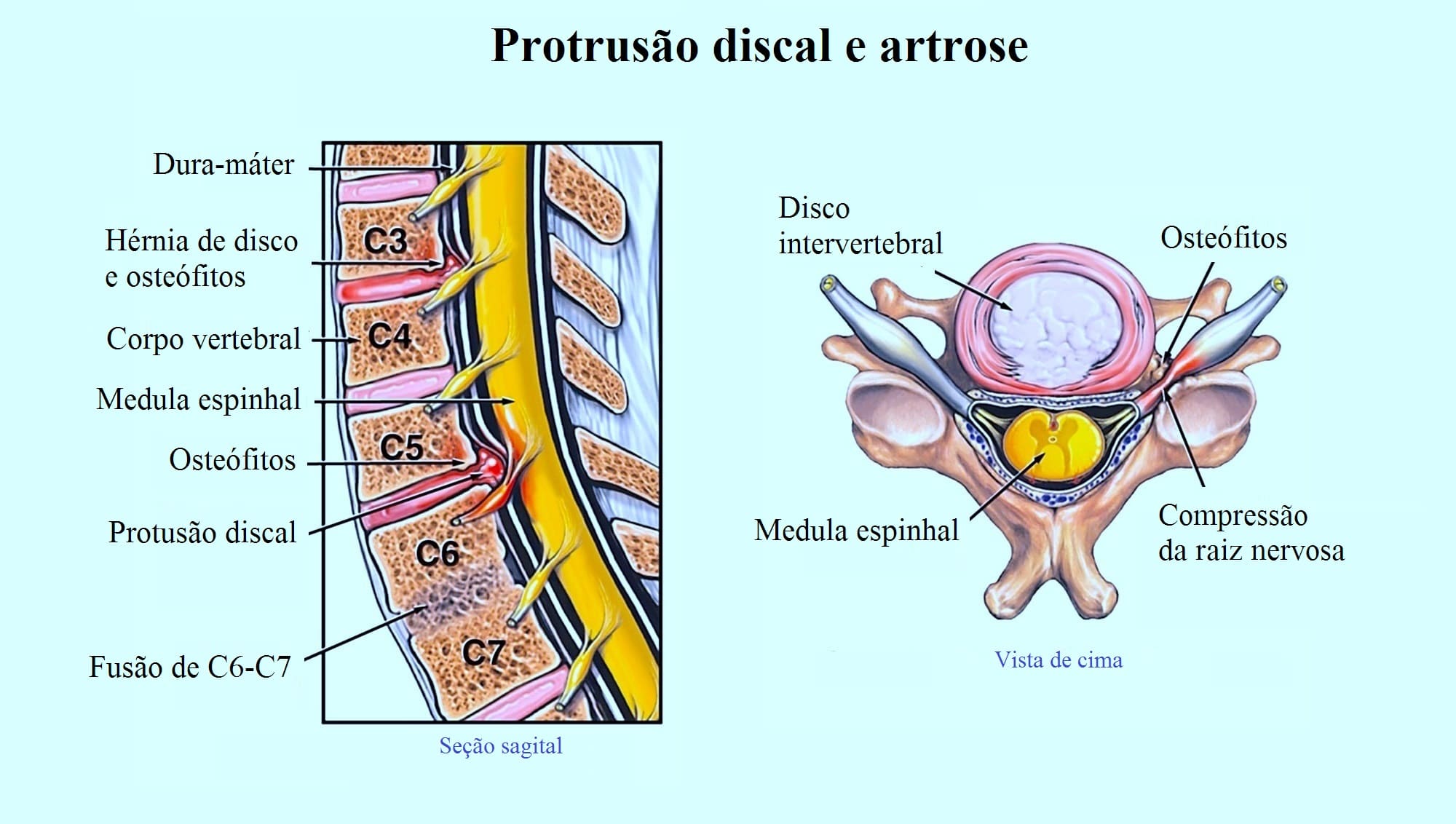 Artrose cervical sintomas tratamento exercícios e remédios naturais