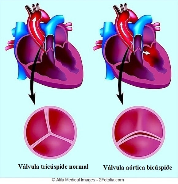 Estenose aórtica valvular sintomas e cirurgia