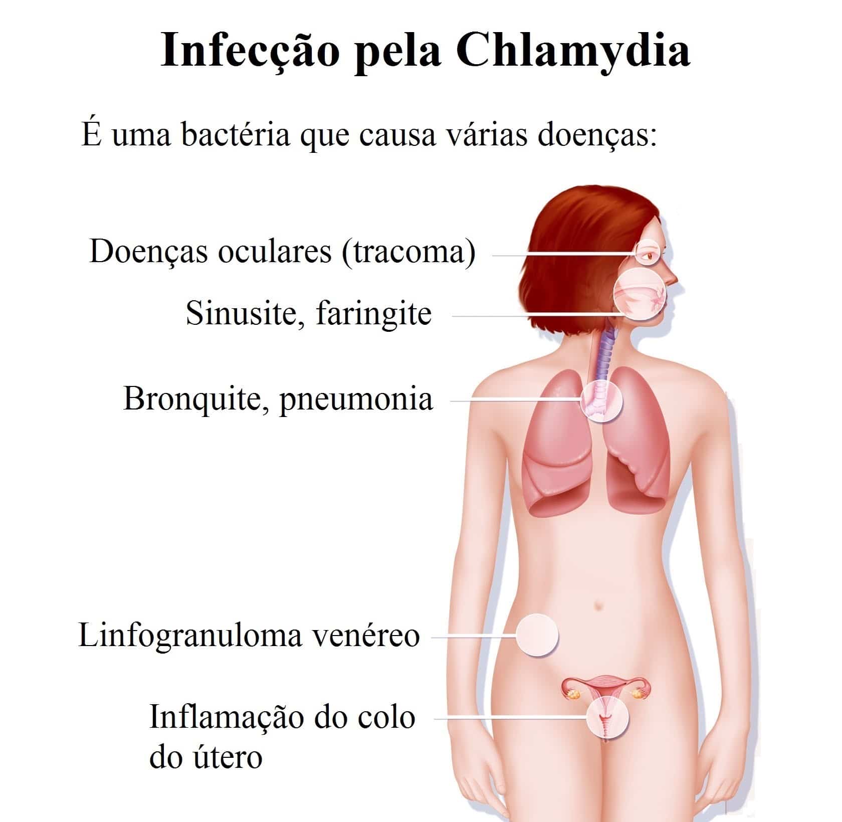 Sintomas da clamídia, teste, remédios e tratamento