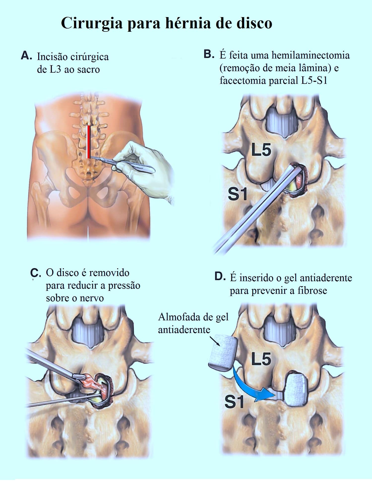 Cirurgia para hérnia de disco lombo-sacral e recuperação