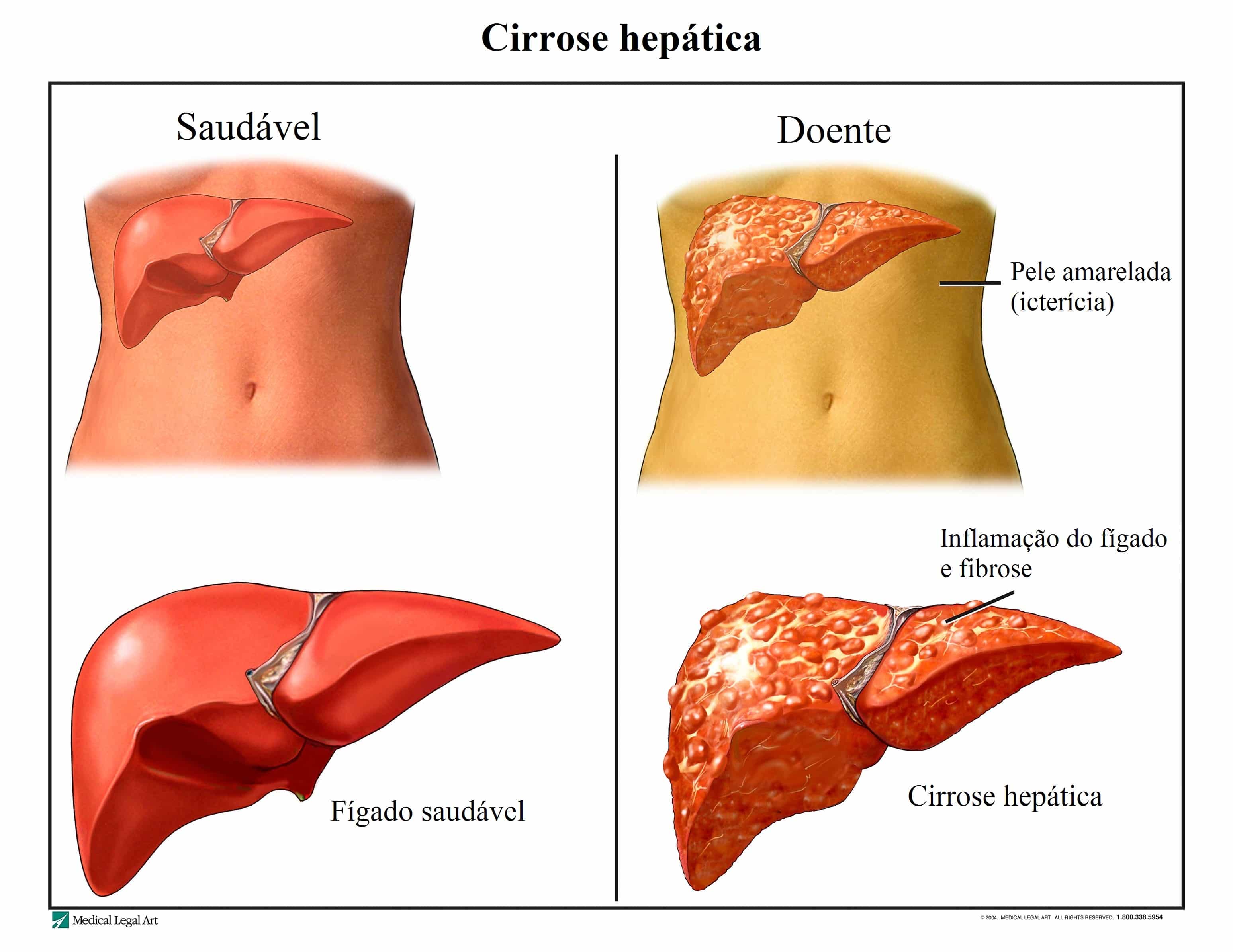 Cirrose hepática, causas, sintomas e complicações