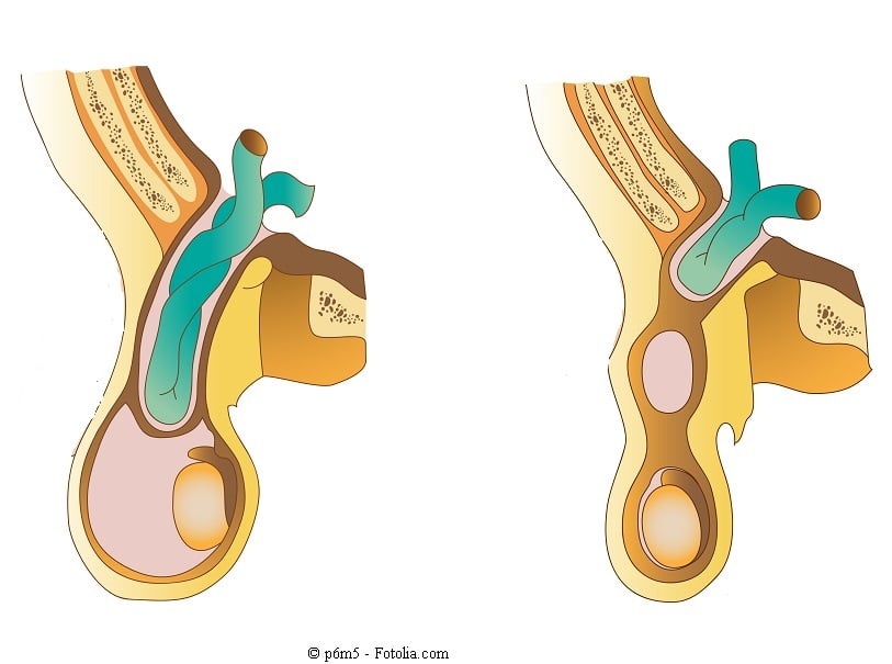 H Rnia Inguinal Direta Ou Esquerda Sintomas E Cirurgia