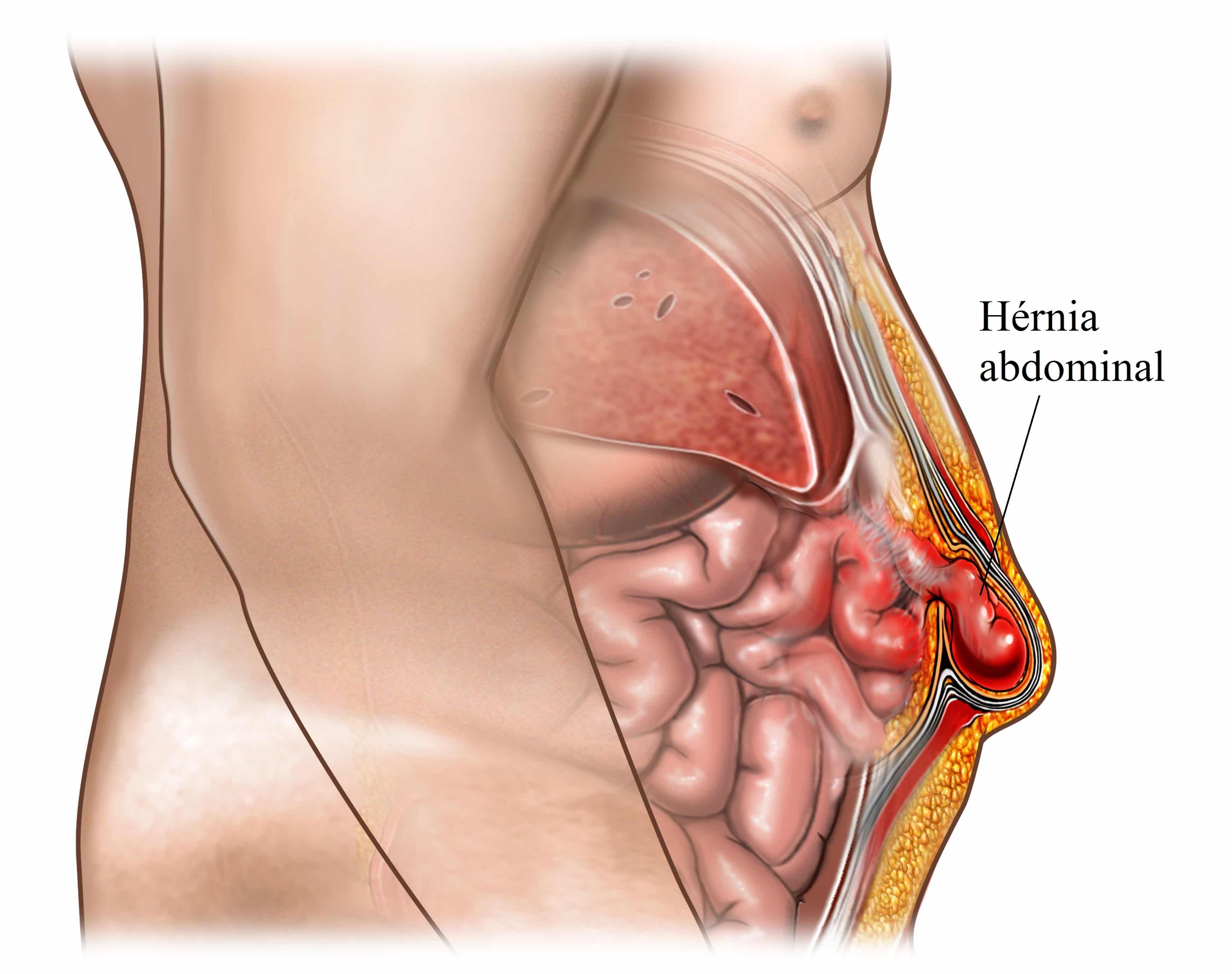 H Rnia Abdominal Fisioterapia Para Todos