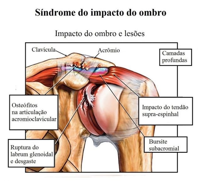 Dor Na Omoplata Esquerda Ou Direita Ombro E Peito