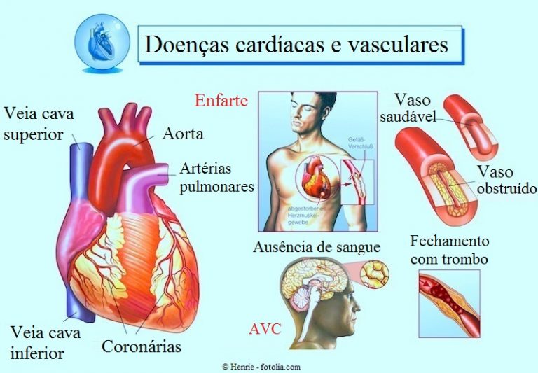 Que Significa Cardiopatia Isquemica Cronica