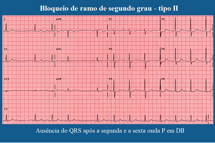 Bloqueio de ramo direito e esquerdo | ECG | divisional e incompleto