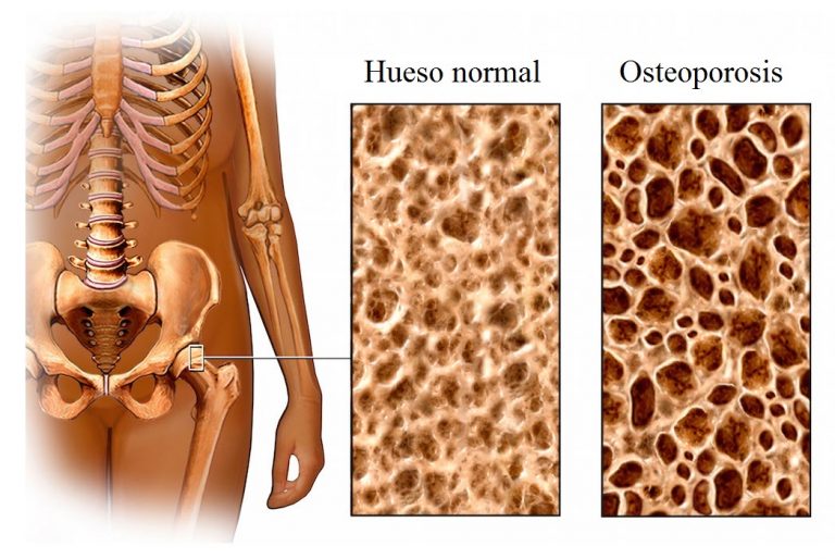 Causas De Osteoporosis Y Tratamiento Nutricional Alimentos Consecuencias 8803