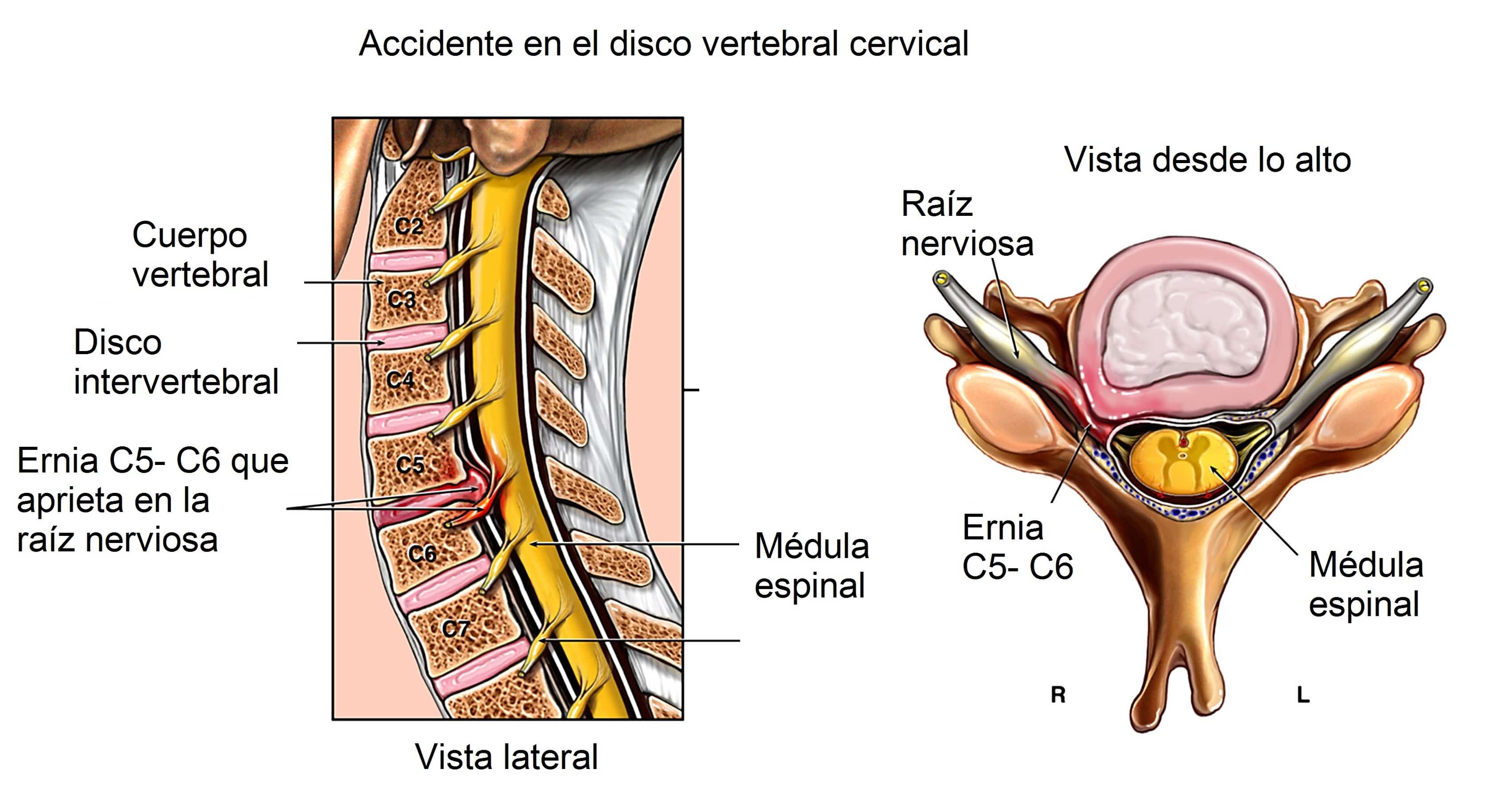 MSP Artritis y Reumatología - #Salud  El dolor cervical puede ser el  resultado de anomalías en las partes blandas, músculos, ligamentos, discos  y nervios, así como en las vértebras y sus