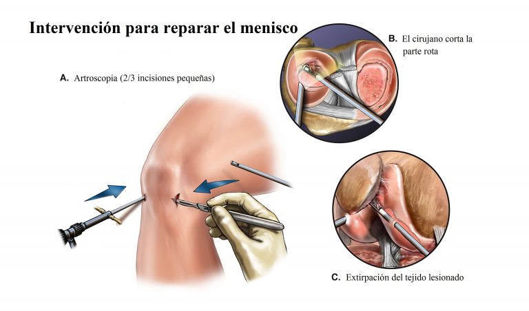 Líquido en rodilla después de artroscopia