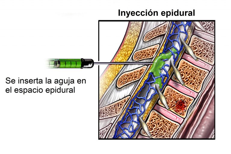 Dolor epidural meses despues