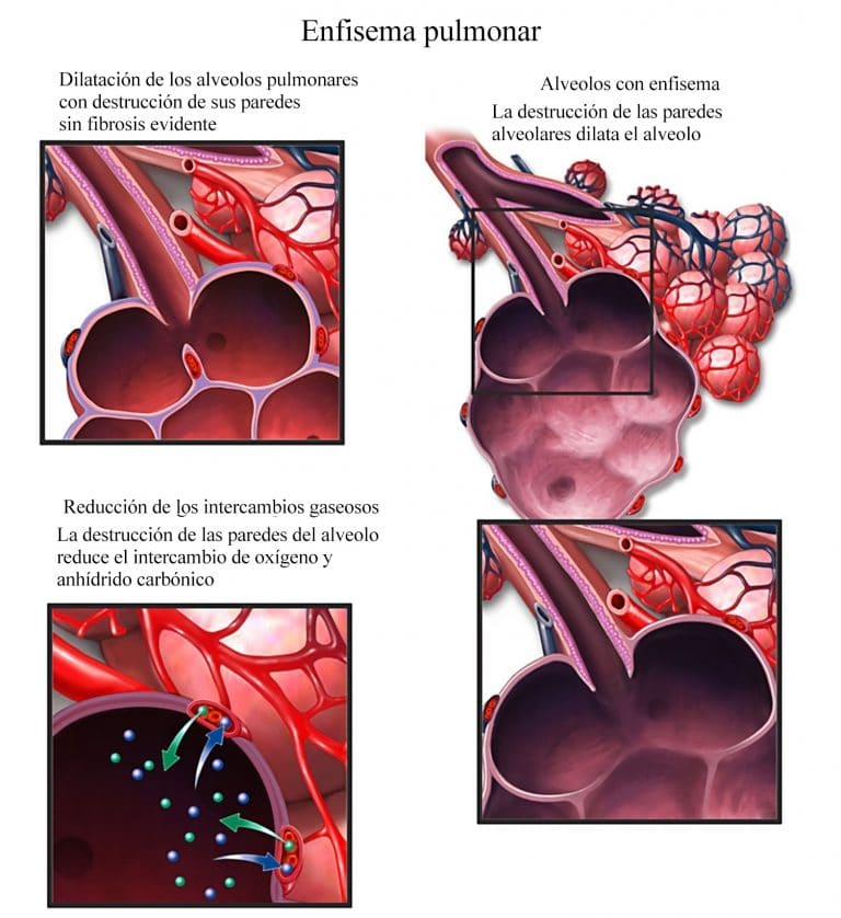 Enfisema pulmonar qué es clasificación y síntomas