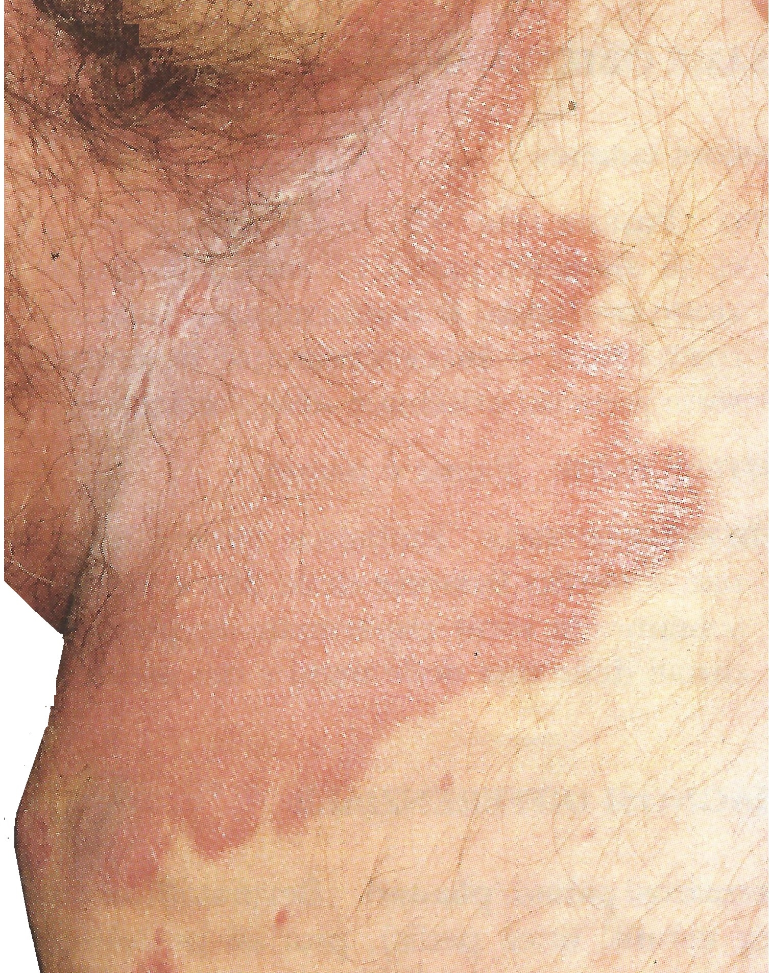 genital psoriasis