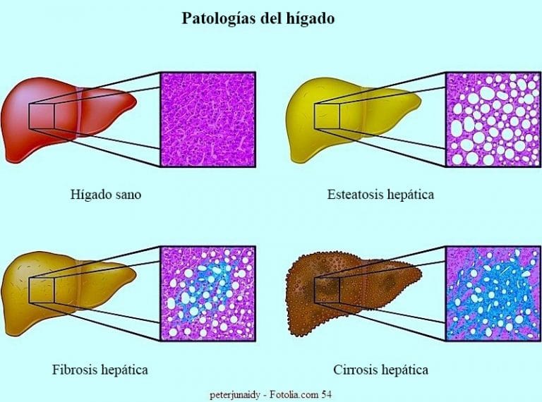 Hepatitis C S Ntomas Como Se Contagia Virus Causas Y Consecuencias