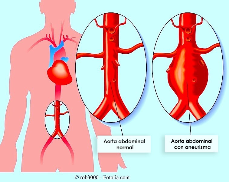 Aneurisma De Aorta Abdominal Ascendente Tor Cica S Ntomas Clasificacion Y Cirug A