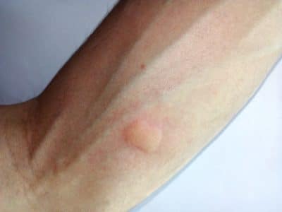 Picadura De Mosquito Tigre Ojo Alergia Infectada Ampolla Y Remedios