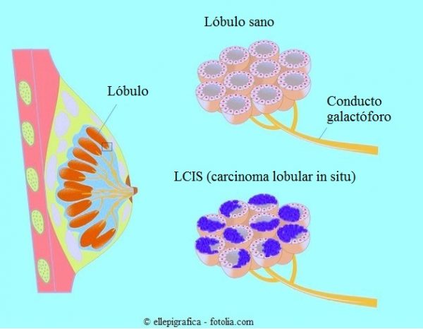 Carcinoma De Mama Lobular O Ductal Tipos Causas Y Síntomas 5007