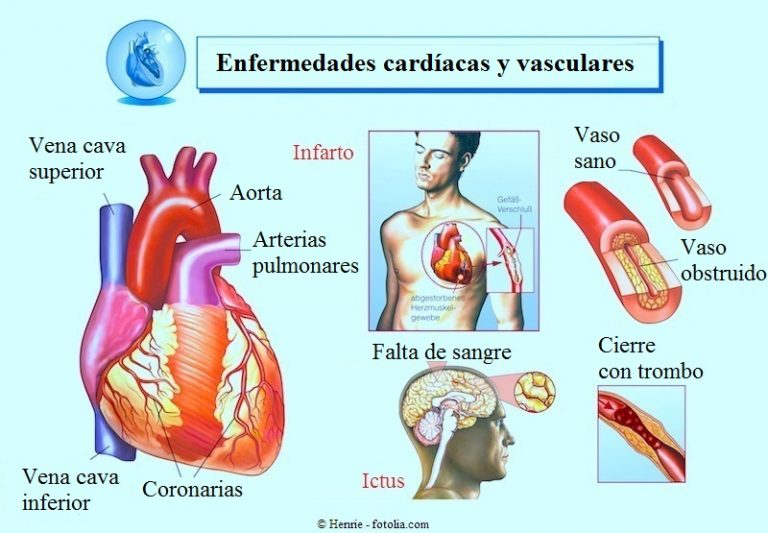 Cardiopatía Isquémica Causas Síntomas Y Complicaciones 2277